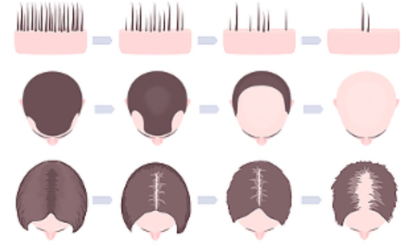 Erkek ve Kadin Tipi Saç Dökülmesi