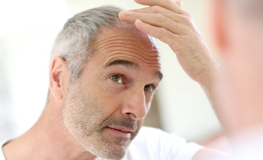 Netra Blog | Saç Dökülmesinin Belirtileri Nelerdir?