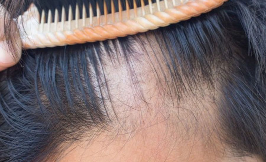 Netra Blog | Saç Dökülmesinin Önlenmesi İçin Alabileceğim Tedbirler Nelerdir?